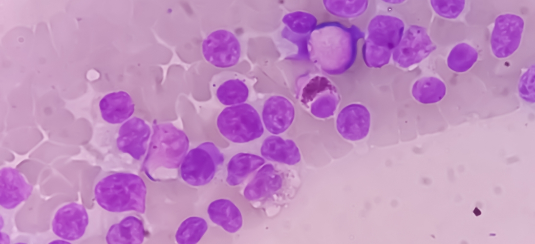 Immunothérapie : vers une nouvelle piste prometteuse  contre les cancers