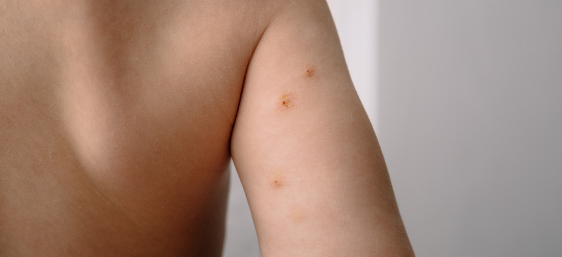 Ce qu’il faut savoir sur le molluscum contagiosum chez l’enfant